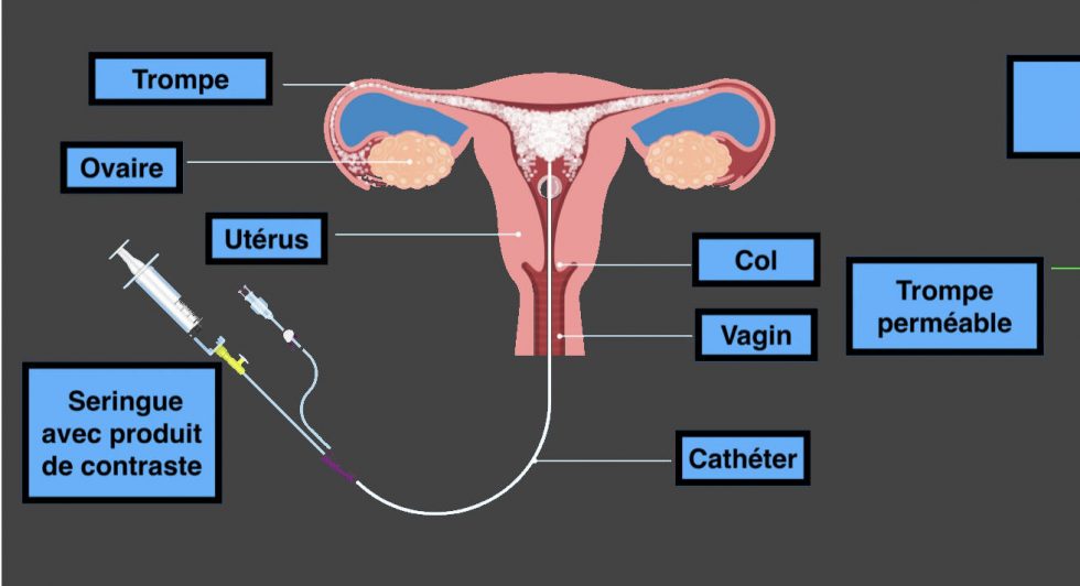 Hystérosalpingographie
